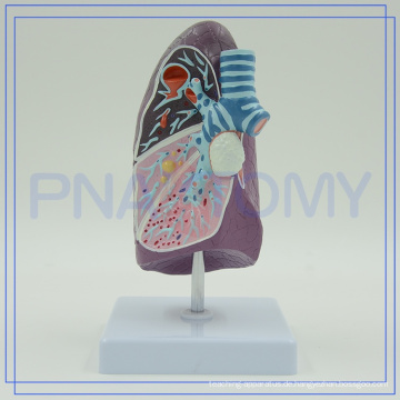 PNT-0732 Pathologisches Modell der Bronchien pulmonales, biologisches Modell